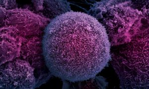 Laser-activated drug a 'leap forward' for prostate cancer treatment